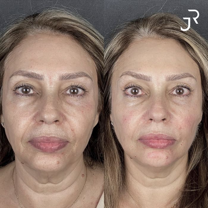 novo-resultados-dr-jhony-3